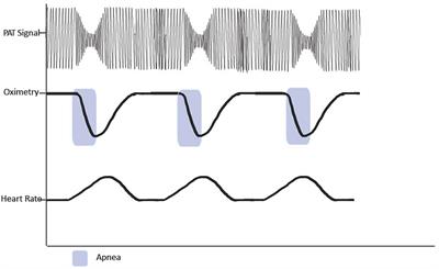 The role of the WatchPAT device in the diagnosis and management of obstructive sleep apnea